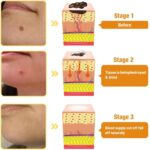 Ximonth Bee Venom Wart Cream Bee Venom Repair Cream