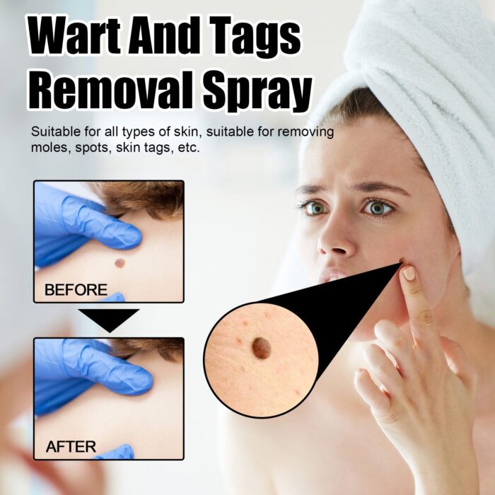 Ximonth Wart And Tags Removal Spray, Cleanse And Fade Body Moles Smooth Skin Repair Spray