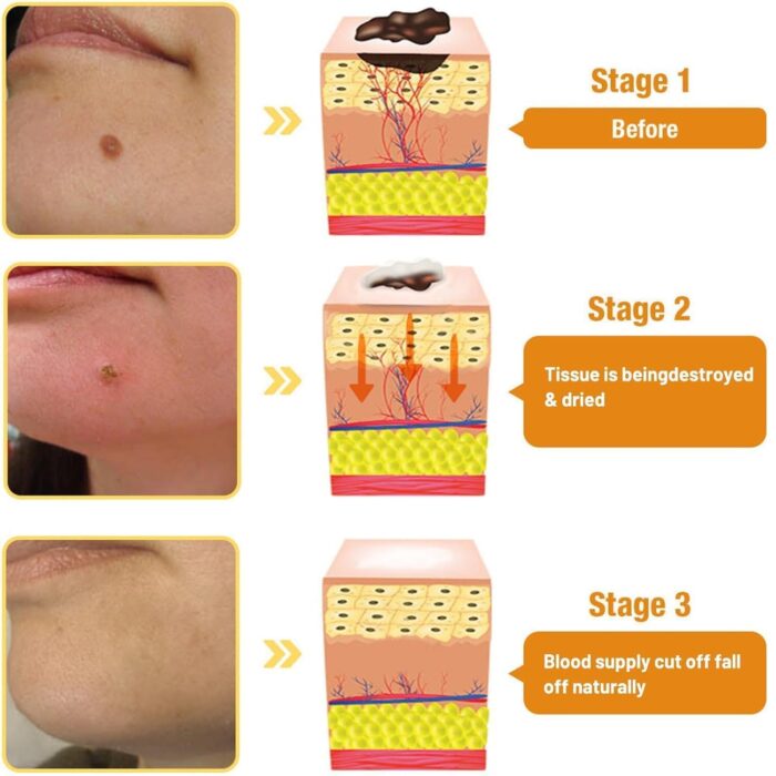 Ximonth Bee Venom Wart Cream Bee Venom Repair Cream