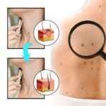 Ximonth Wart And Tags Removal Spray, Cleanse And Fade Body Moles Smooth Skin Repair Spray
