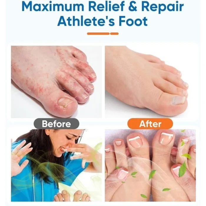 Ximonth Foot Spray with Tea Tree Oil Tea Tree Oil Feet Spray 2PCS