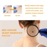 ximonth Bee Venom Wart Remover Patch, Gently Clean Skin Fade Flesh Granules Flesh Nevus Remove Warts Smooth Skin Patch