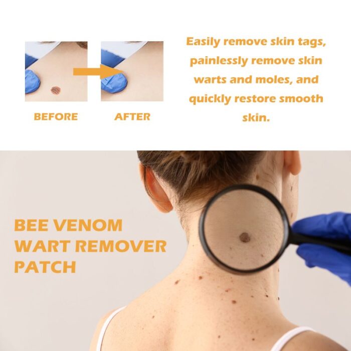 ximonth Bee Venom Wart Remover Patch, Gently Clean Skin Fade Flesh Granules Flesh Nevus Remove Warts Smooth Skin Patch