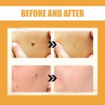 ximonth Bee Venom Wart Remover Patch, Gently Clean Skin Fade Flesh Granules Flesh Nevus Remove Warts Smooth Skin Patch